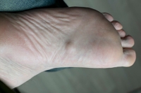 Symptoms and Causes of a Plantar Fibroma