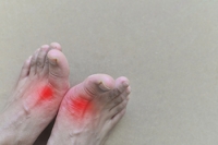 Symptoms of Gout