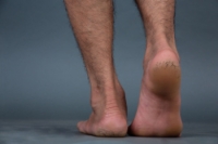 Cracked Heels and Their Causes