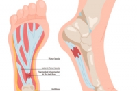 Key Insights Into Foot Pain From Plantar Fasciitis