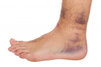 What Is a High Ankle Sprain?