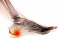 Who Is Prone To Developing Heel Spurs?